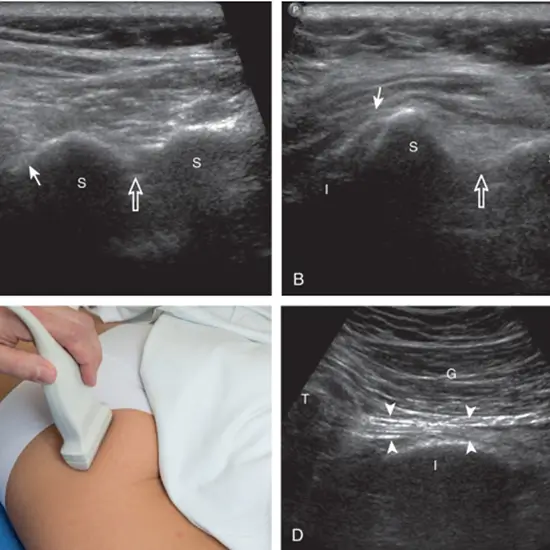 Ultrasound Hip Joint